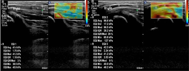Elastografia tempo formacion 3.jpg